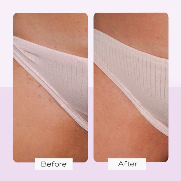 First Aid Beauty Ingrown Hair Treatment Pads (28 Pads) VIP-Rabatte