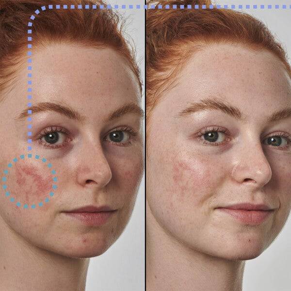 The INKEY List Super Solutions 10% Azelaic Acid Serum 30ml Preisnachlass