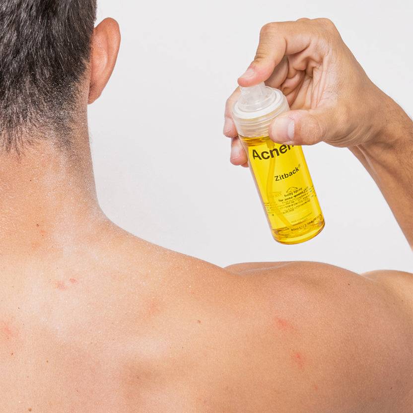 Acnemy Zitback® (80ml) Riesige Rabatte